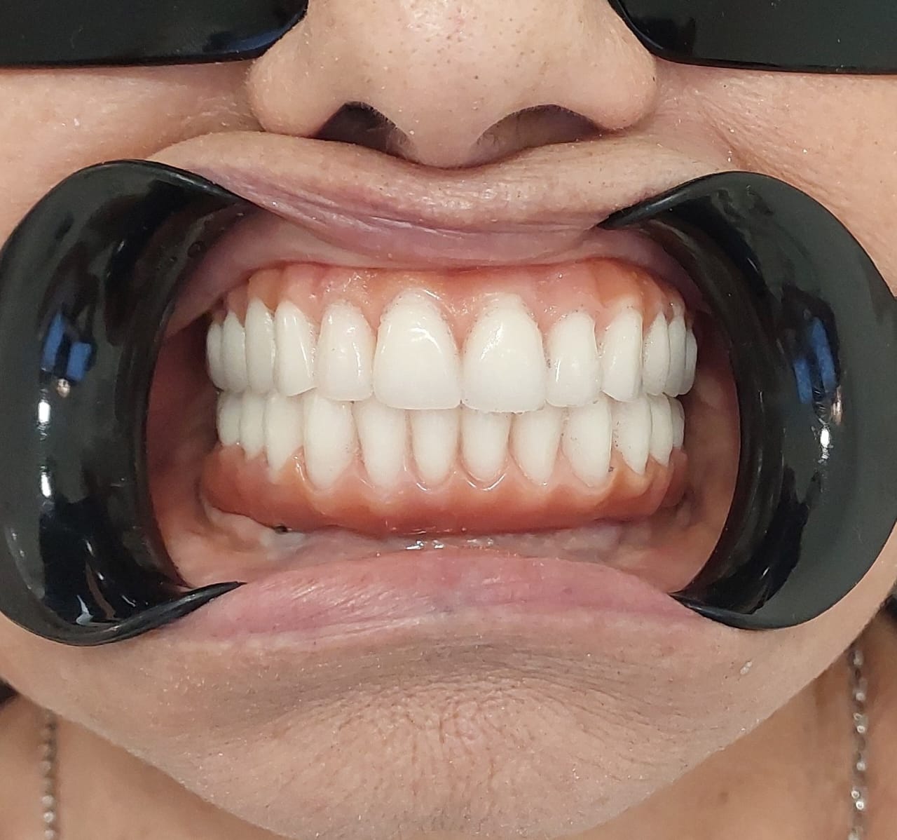Depois — Reabilitação total sobre implantes