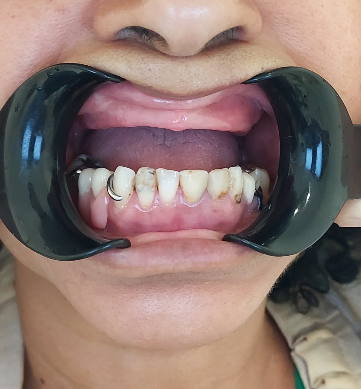 Antes — Substituição de dentes comprometidos