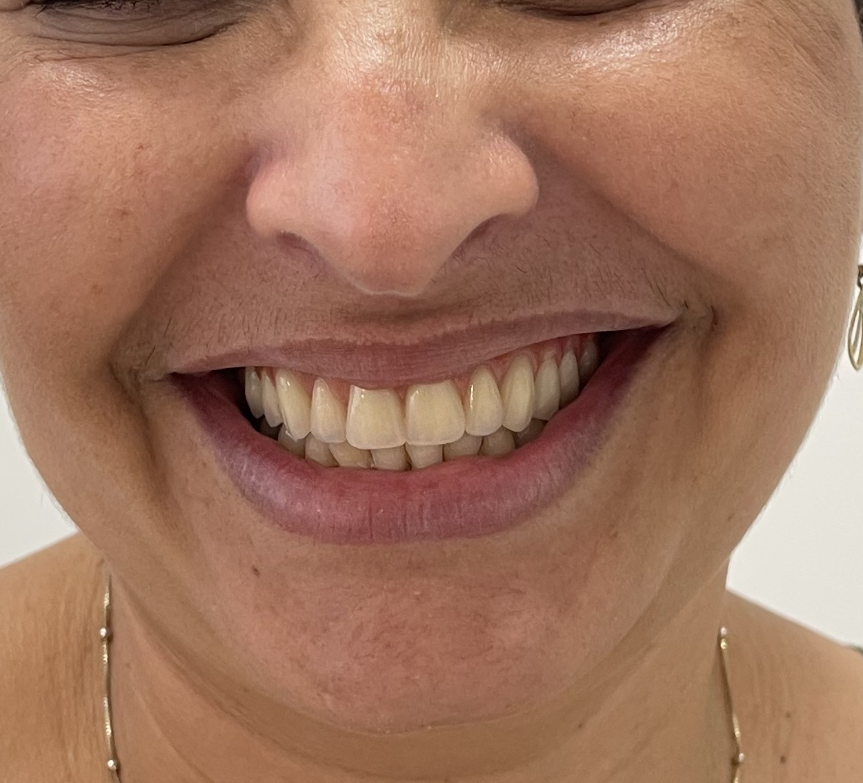 Depois — Devolução da estética e autoestima
